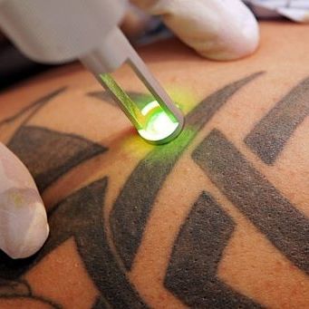 Erasuretattooremoval