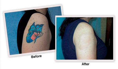 Tattooremovaldoc