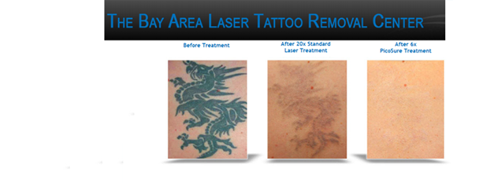 TheBayAreaLaserTattooRomovalInstitute