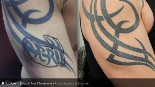 Arm Tattoo Removal before and after1