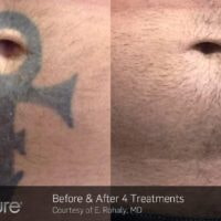 Belly Tattoo removed using Picosure laser 