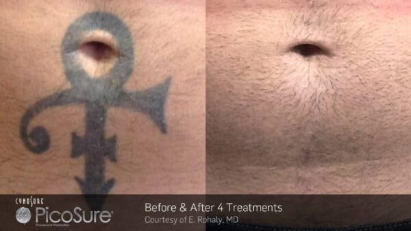 Belly Tattoo removed using Picosure laser