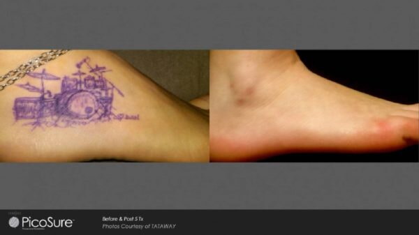 Foot tattoo removal using laser