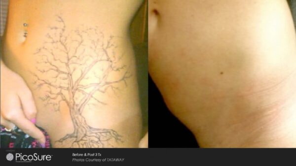 Laser Tattoo Removal Before & after
