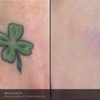 Laser Tattoo Removal – before and after 
