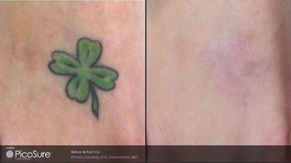 Laser Tattoo Removal – before and after