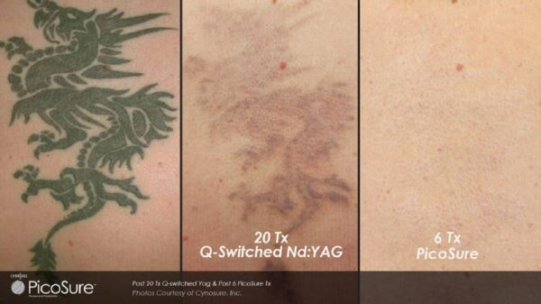 Tattoo removal using PicoSure laser – before and after