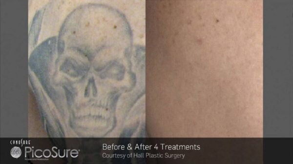arm tattoo removal at Lazer Wizard